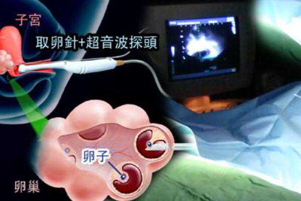 2023北京供精试管婴儿流程,选择北京三代试管医院需要注意哪些问题？